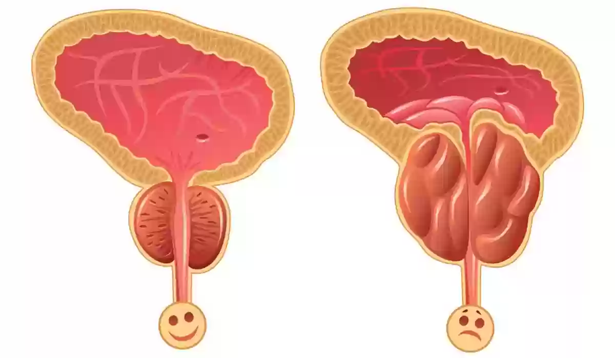 ما الفرق بين تضخم البروستاتا الحميد والخبيث